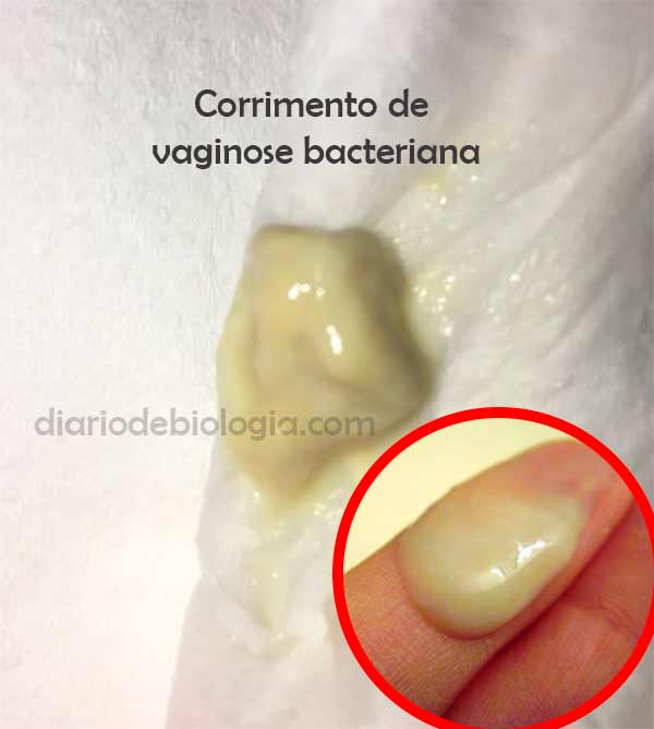 vaginose bacteriana